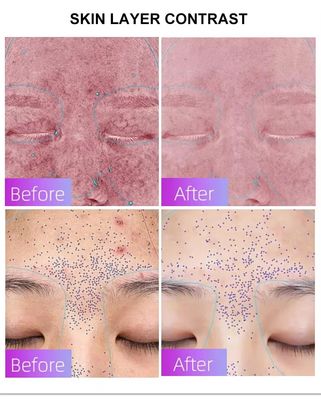 Beli Blue Light Acne Treatment Mask with Intelligent Timer – Manufacturer Direct Supply, Appearance Patent Included pembuatan online